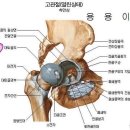 대퇴골두무혈성괴사 이미지