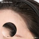 헤어라인 이미지