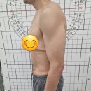 수지척추체형교정