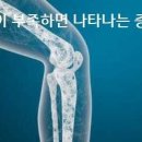 칼슘이 부족하면 나타나는 증상 7가지 이미지
