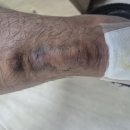 2년전에 수술한 부위에서 드레인이 나왔네요.. 이미지