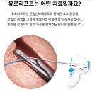 유로센터비뇨기과의원 | 강남유로비뇨기과 유로리프트 전립선결찰술 어느 부분에 집중할 수 있을까요?