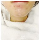 붉은천 | 여드름 염증주사 가격 후기 개당 천원 피부과 여신티켓 추천인