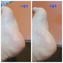 라벨영 : 발각질제거제 쇼킹닥터피쉬테라피 사용 찐 후기~