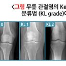 천심련 추출물 과 관절염증, 섭취방법과 이미지