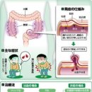 대장게실증(大腸憩室症)…자루모양의 돌출 출혈이나 염증 이미지