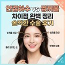 차이 | 안검하수 쌍꺼풀 차이 상안검수술 + 솔직 후기