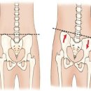 골반교정 필라테스 이미지
