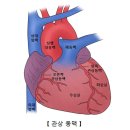 오래된 심근경색증[Old myocardial infarction]순환기질환 이미지