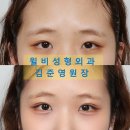 자연유착 후기 [윌비성형외과 김준영 원장] 눈 겹주름 해결