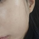 제이스타성형외과의원 | 강남 제이필의원 필러녹이는 주사 시술 후기 (필러부작용)