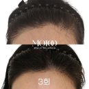 그로우모모 두피 탈모 케어센터 이미지