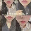 앵두미인 | 강남입술필러 잘하는곳 가격 아깝지 않은 1cc 리얼후기