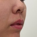 리온의원 | 부산 서면역 근처 이중턱 온다리프팅 내돈내산 만족후기