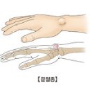 갱글리온(결절종 Ganglion)이 아프다 = 답하는 사람 사이토 교수(간사히 의대 종합의료센터. 정형외과) 이미지