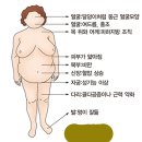 부신 질환 - 피로 - 스트레스 지속 이미지