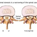 척추관 협착증 이미지