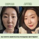 라임 | [압구정피부과] 울쎄라피프라임 내돈내산 후기, 처진 볼살 끌어올려 팔자 없앤 후기