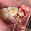 단계뿌리깊은치과의원 | [아산 연세원치과]멀쩡해 보이는 사랑니가 어떻게 '두 번째 큰 어금니'를 소리 없이 파괴하는가