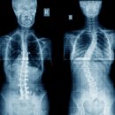 scoliosis(측만증) 이미지