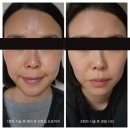 청담포유의원 | 서면 경성대 피부과 / 기미 영혼까지 뽑은 후기