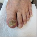 포쉬네일 풀리메디 안산점 | 초지역발톱무좀 친절하고 완벽했던 관리 포쉬네일 풀리메디 안산점