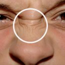 큐브성형외과의원 | 시흥성형외과, 콧등 보톡스 제대로 맞으려면?