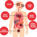 고혈압의 합병증 이미지