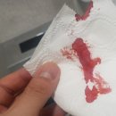 오약국 | 치질 좌약 약국 사용 후기 + 해결법