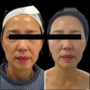 매순간, beauty | [대구 피부관리] 비싼 온다 대신 티리온X, 병원 장비 원리로 리프팅 후기
