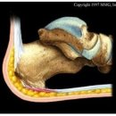 족저근막염(20150724) 이미지
