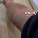 수원남문이의원 | 수원남문이의원 수원 타투 문신 레이저 제거후기(징그러움 주의)