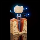 미소를심는서울치과의원 | 상봉동치과, 치아가 빠졌다면? 임플란트로 기능과 미소를 지켜주세요!