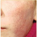 ND(엔디)두피 | 모공각화증(Keratosis Pilaris)과 치료에 대해서(요청글)
