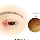 눈염증 안검염 증상, 눈기름샘 청소 (눈꺼풀 여드름, 눈에기름, 마이봄샘) 이미지
