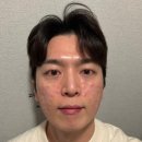 서울예쁨의원 | 강남 피부과 30대 남자 필로드 스킨부스터 후기 [신논현 예쁨주의쁨의원]