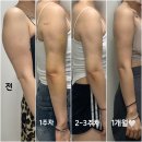달;보다 | 수원팔뚝지방추출주사 한 달 후기 팔라인 전후 변화 비교