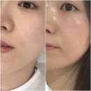 현메디칼 | 부산 슈퍼젝션 엠뮤에서 받은 신부관리 끝판왕 뮤톡스 후기