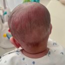 아이러브강남의원 | 아기 두상교정헬멧 과정 - "아이러브헬멧" 상담 및 피팅후기