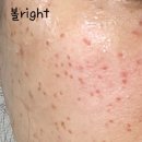 휴니즈 | 2023년 1월 편평사마귀 제거 후기2 (징그러울수 있음)