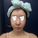 타임디자인 | 압구정 올타이트 리프팅, 압구정피부과전문의에게 받은 다운타임 없는 후기