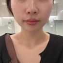 스킨더:뉴 | 부산 지방개선주사 뉴코어 스킨 후기 뉴비쥬 + 코어톡스로 브이라인 턱선 만들 수 있어요