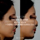 부천 피부과 올리지오 400샷, 더모톡신 후기 및 전후비교