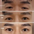 더(The)예쁜얼굴만들기성형외과의원 | 남자눈성형전후, 무쌍 눈매교정으로 느끼하지 않고 또렷하게