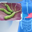 헬리코박터균, 제균치료 하면 끝? 재검사받아야 이미지