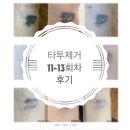모현아름다운의원 | [익산] 타투제거 후기 마지막 11-13회차