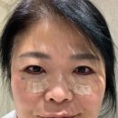 40대 하안검 수술 후기 - 부작용 수술자국