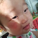 이지덤 자국 이미지