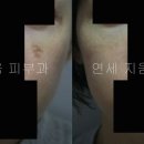 ＜＜＜＜＜＜＜＜＜＜＜＜＜＜＜레이저토닝 부작용, IPL 부작용 치료. 연세지움피부과.＞＞＞＞＞＞＞＞＞＞＞＞＞＞＞＞ 이미지