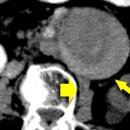 대동맥류 (Aortic Aneurysm)